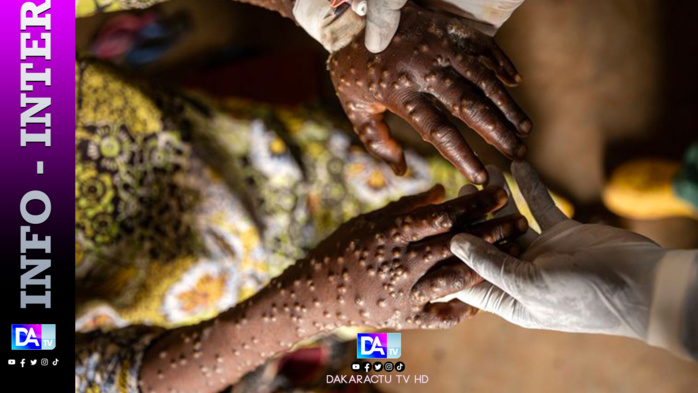 Premier cas de mpox en Guinée 