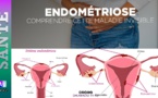 Santé : Zoom sur l'endométriose, cette maladie qui gâche la vie des femmes